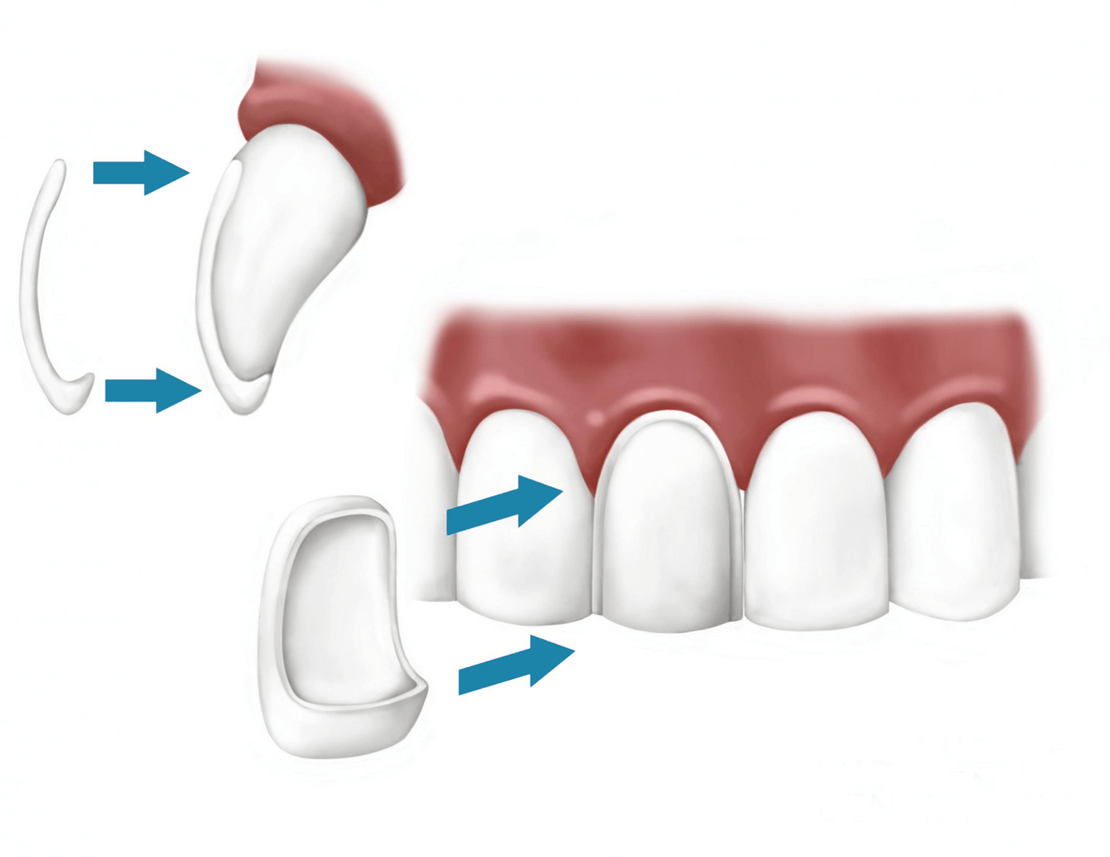 Як ставлять вініри на зуби?