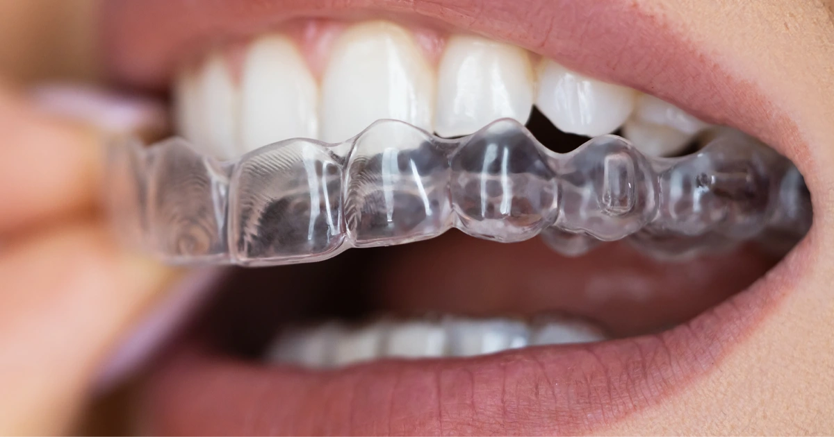 Елайнер. Вирівнювання зубів без брекетів
